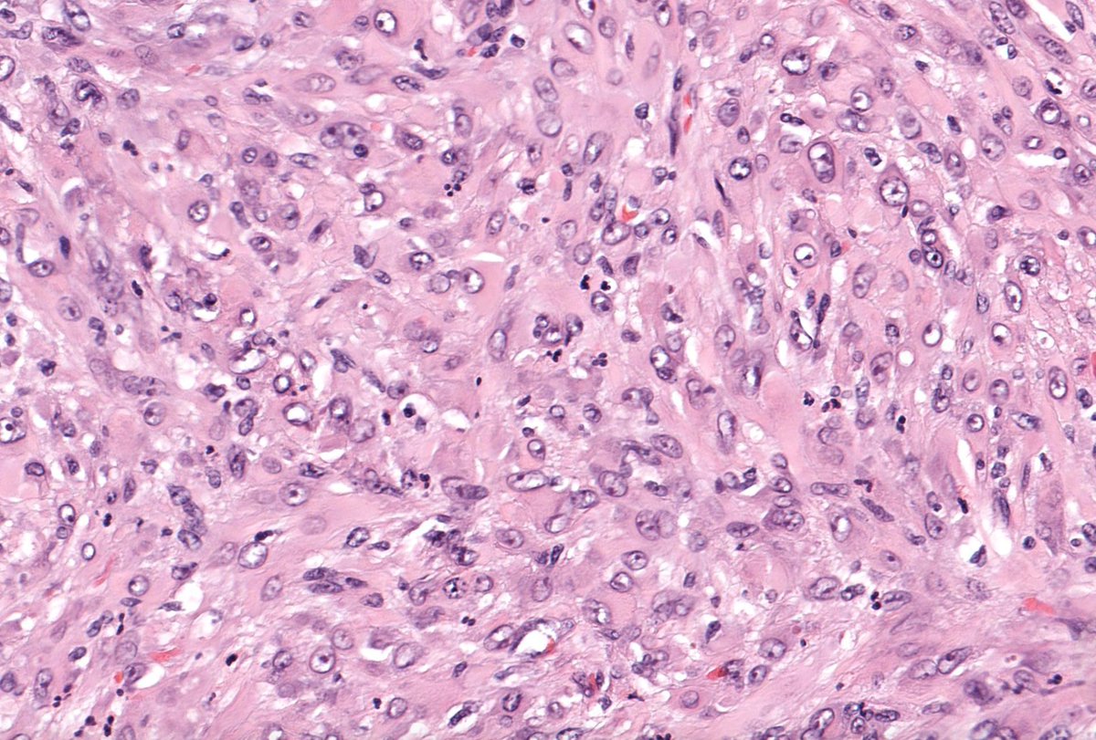 20 M. Thigh nodule. Diagnosis from one pic, or #TooCloseToDiagnose? What's the clue?
Answer ✅ youtube.com/watch?v=JCgC-b… 
Digital slide: kikoxp.com/posts/21731 
IHC: kikoxp.com/posts/21733
#pathology #pathTwitter #dermpath #dermtwitter #BSTpath