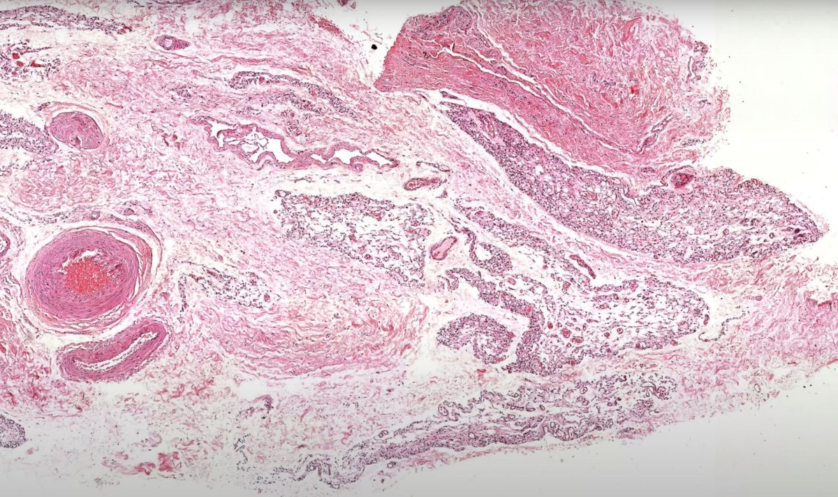 What are these cellular lobular areas made of? 
Answer ✅  youtu.be/n96X04rhZds 
#pathology #pathologists #pathTwitter #dermpath #dermatology #dermatologia #dermtwitter #BSTpath