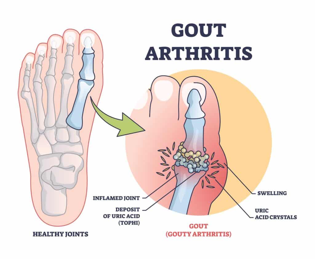 A patient with hypertension &amp; gout .

Which antihypertensive is preferred?

A. Hydrochlorothiazide
B. Furosemide
C. Losartan
D. Atenolol