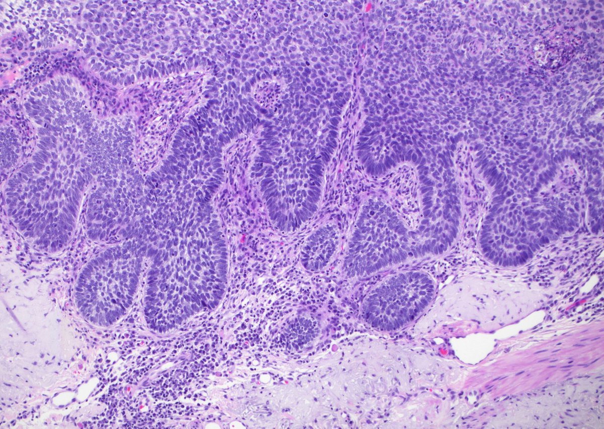 80 yo M with crusted ulcerated skin lesion on temple.
Diagnosis? What are all those cells in the dermis???
Answer ✅ youtu.be/FvHGiXDqwr8  
#pathology #pathologists #pathTwitter #dermpath #dermatology #dermatologia #dermtwitter