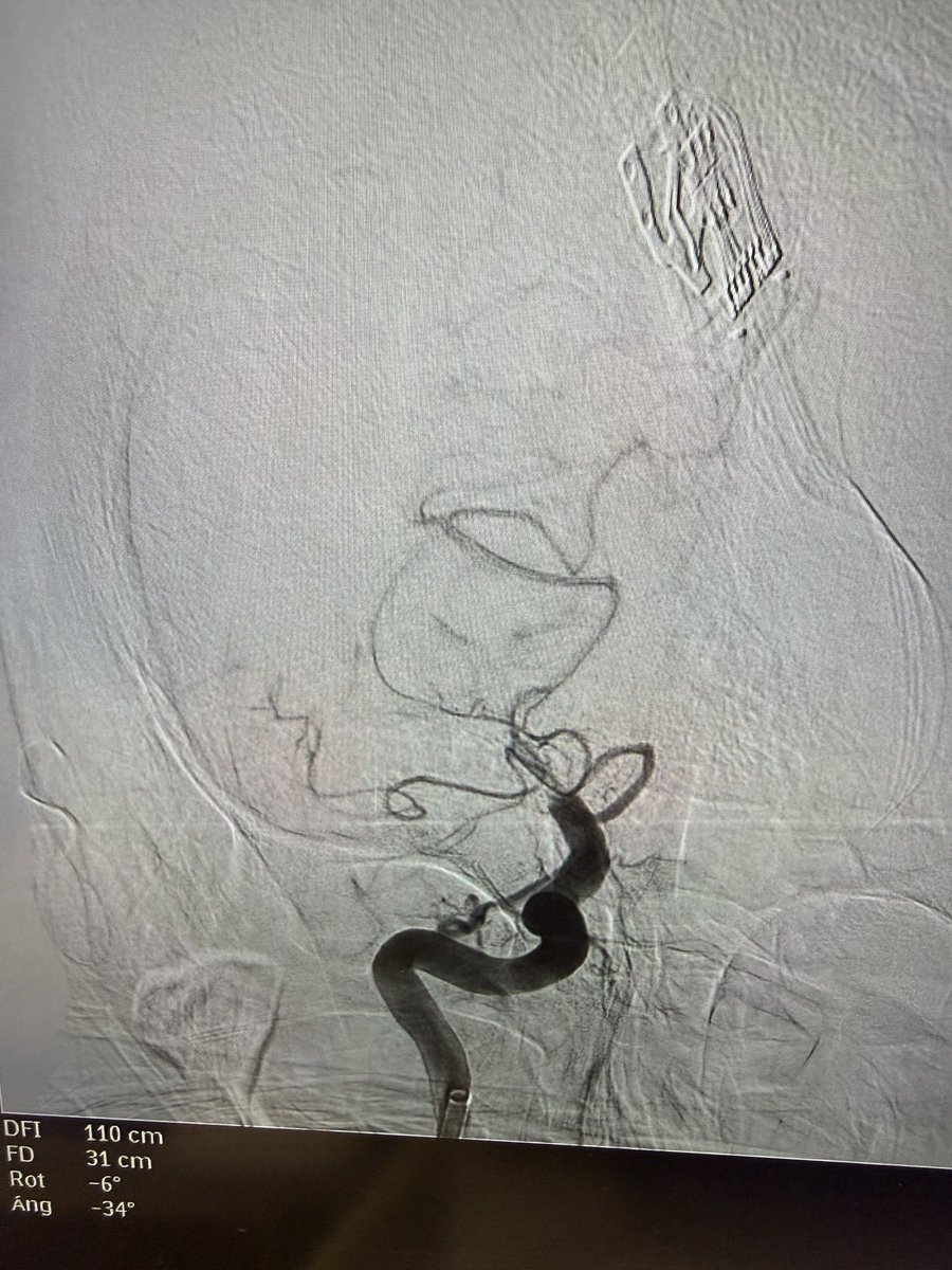 J_Haller's tweet image. Cansado pero profundamente satisfecho. Siete minutos, movilidad y lenguaje recuperados en agudo.