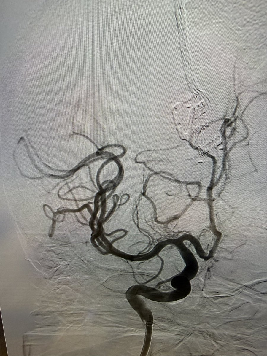 J_Haller's tweet image. Cansado pero profundamente satisfecho. Siete minutos, movilidad y lenguaje recuperados en agudo.