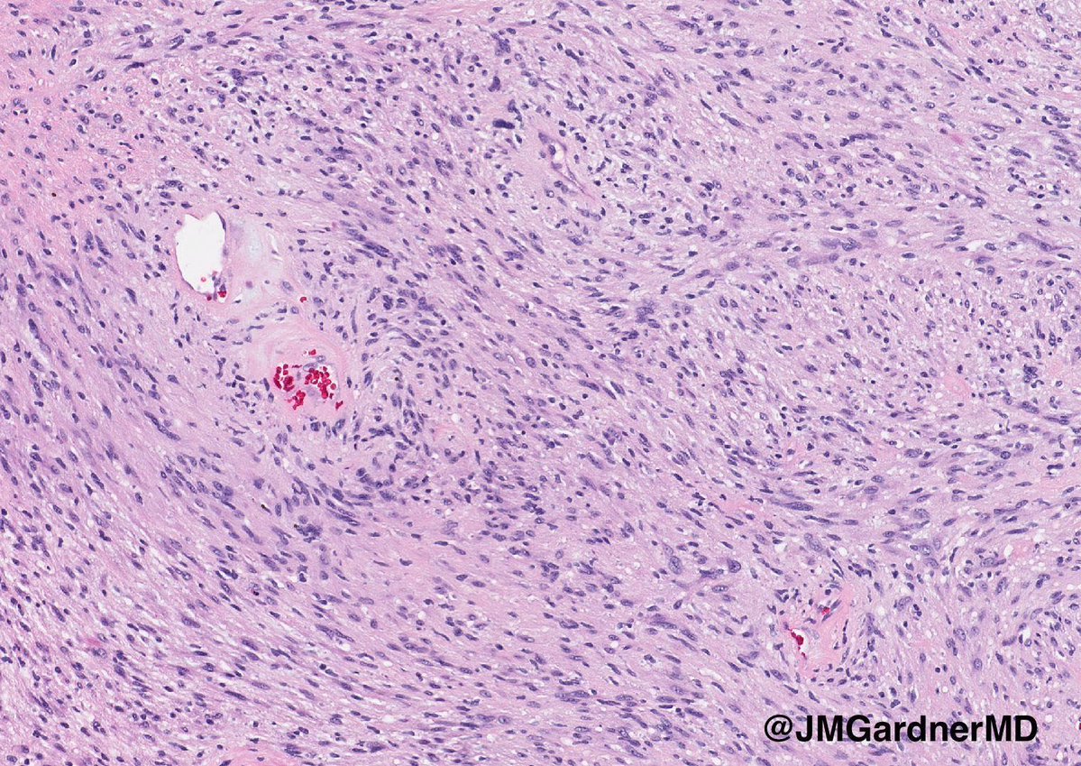 "Cyst" on the trunk of an adult. Your diagnosis? (Hint: it's not a cyst!) 
Answer ✅ youtube.com/watch?v=0447D-… 
#pathology #pathologists #pathTwitter #dermpath #dermatology #dermatologia #dermtwitter #BSTpath
