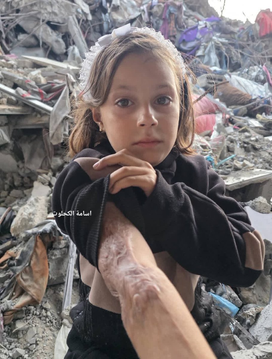 The girl Amna Al-Harsh "7 years old" the only survivor of her family after their house was bombed and her parents and two sisters and 11 of her relatives were martyred. Amna woke up to a rocket that destroyed her home, and a shrapnel stuck to her hand, causing burns and severe