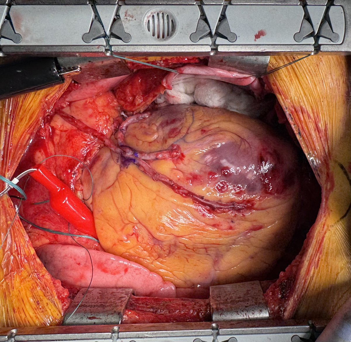 GianTorre610's tweet photo. After #ICC2025 I spent few days in my OR with dr Minh Kim, Dr Jan Vojacek and Dr Stepan Czerny performing and discussing total arterial #CABG off pump and #Robotic #TECAB. I get to learn so much by these visiting exchange. Thanks Peters Surgical to make it happen! https://t.co/RHXNdJ5Pok