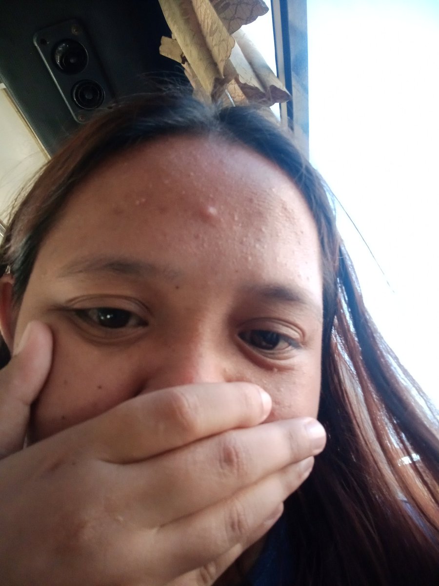 parang gago yung tigyawat ko bwiset. pumwesto pa talaga siya sa gitna tangina