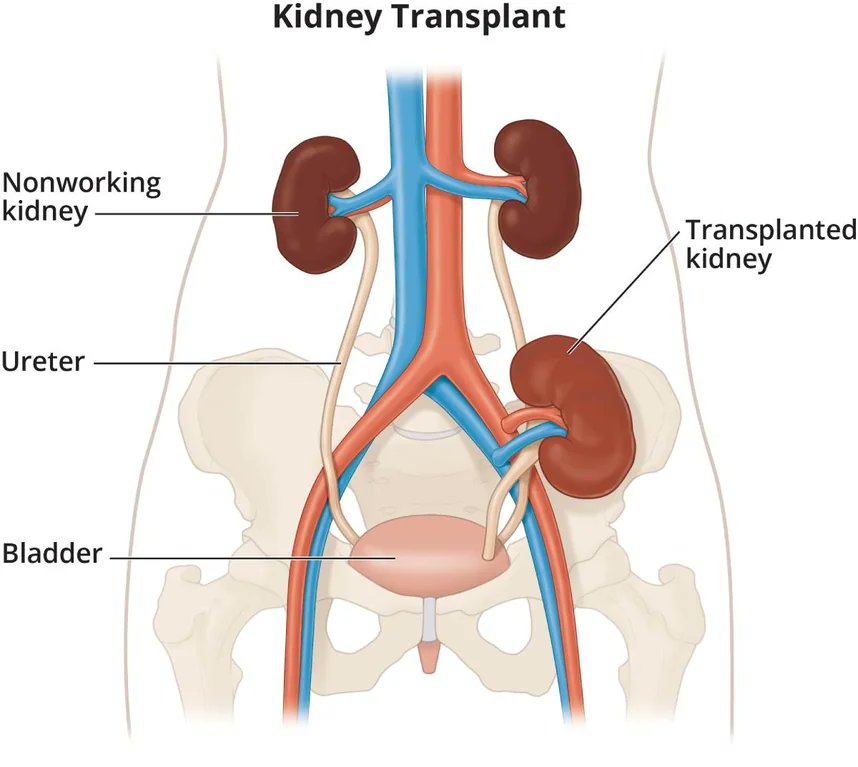 When you have a kidney transplant done, doctors just give you a third kidney.

This is a thing that a surprisingly low number of people know: believe it or not, I even met doctors (obviously not specialized in surgery) who didn't know it.