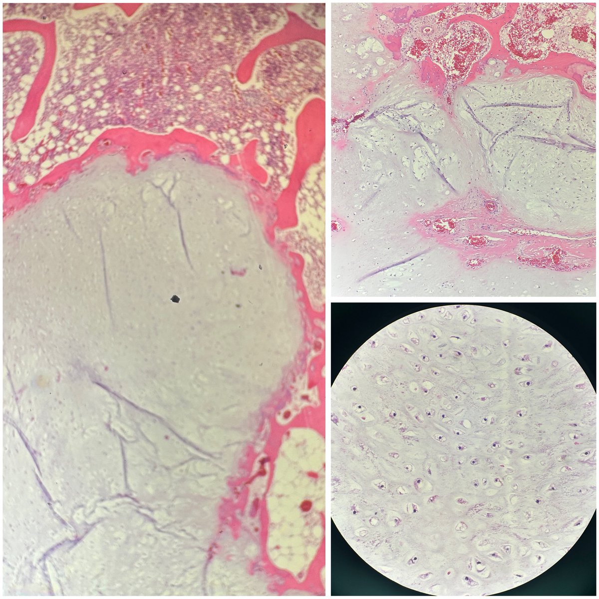 NITHYAPREM3's tweet photo. 38 year old female presented with chest wall pain related to lower rib. CT : small exophytic bony lesion with cartilaginous density, no evidence of invasion.  
# gross and H&amp;E images 

Diagnosis: Enchondroma https://t.co/eGUup9SqFg