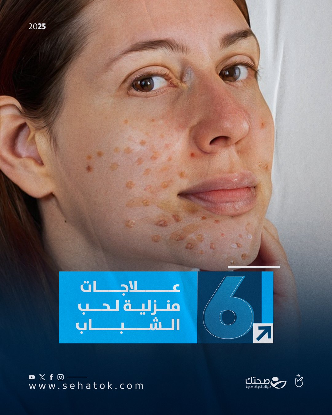 إليك 6 علاجات منزلية شائعة لحبّ الشباب يمكن أن تساعد في التخفيف منه عند الاستخدام الصحيح. يُنصح دائمًا بتجربة أي علاج على جزء صغير من الجلد أولًا، ومراجعة طبيب الجلدية في الحالات الشديدة 