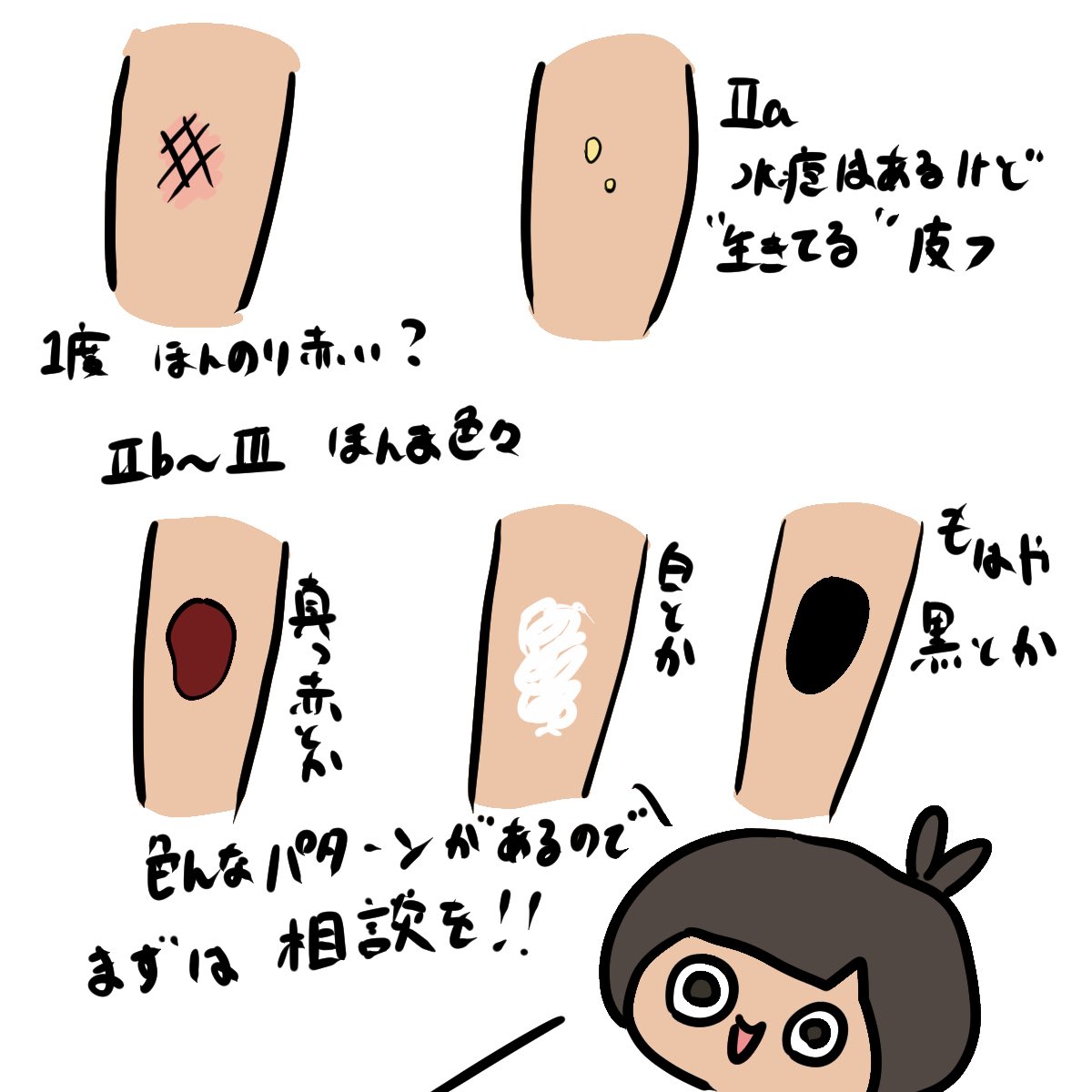 熱傷はすぐに病院へ」 Ⅰ度・浅いⅡa度熱傷は適切な処置で自然上皮化が