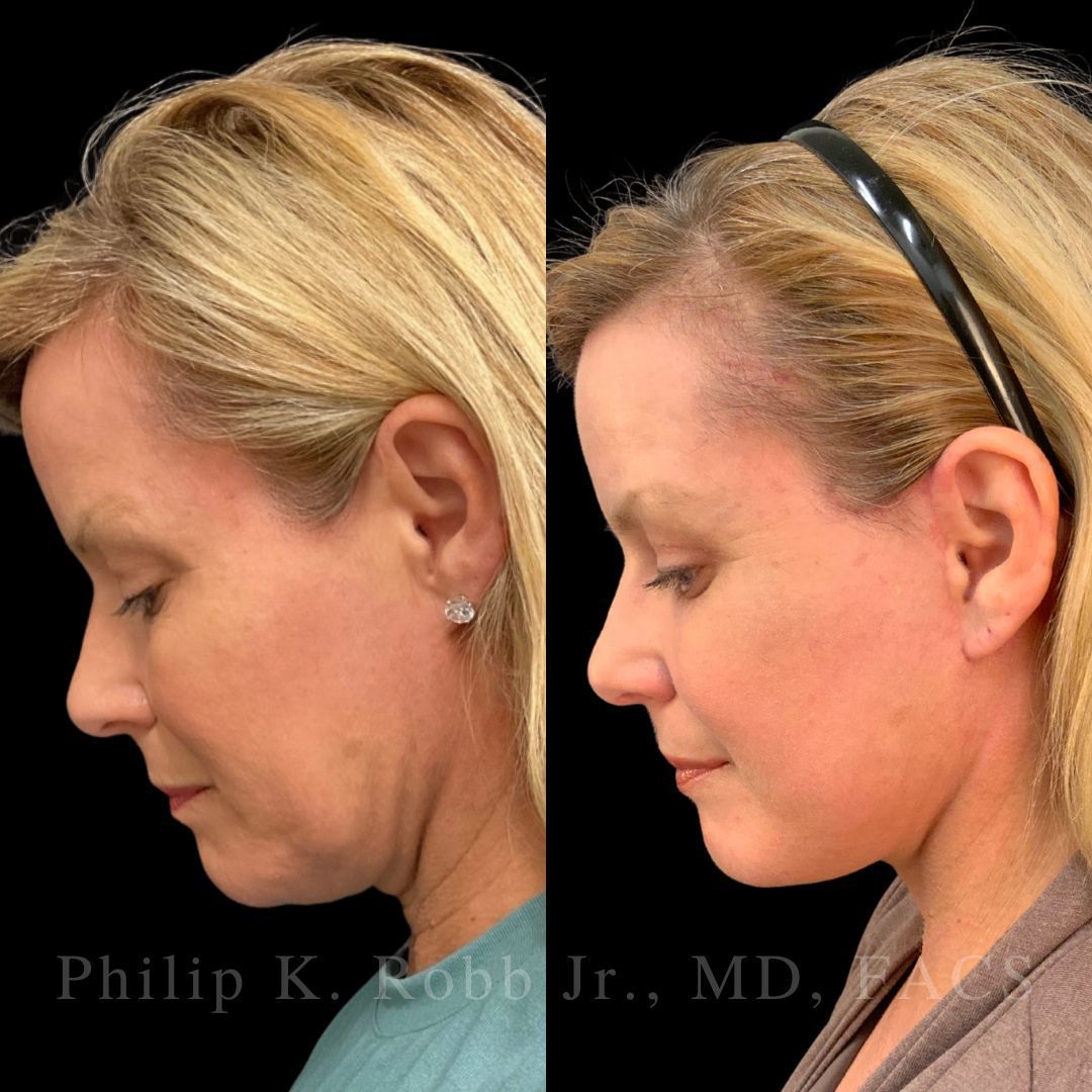 RobbJrMD's tweet image. Swipe to zoom in on the DETAILS 👀

This patient is just 8 weeks out from her Robb Refresh🙌🏼

When we lift in the deep plane, we’re not pulling the skin — we’re moving the actual aging structures back to where they lived years ago🤩