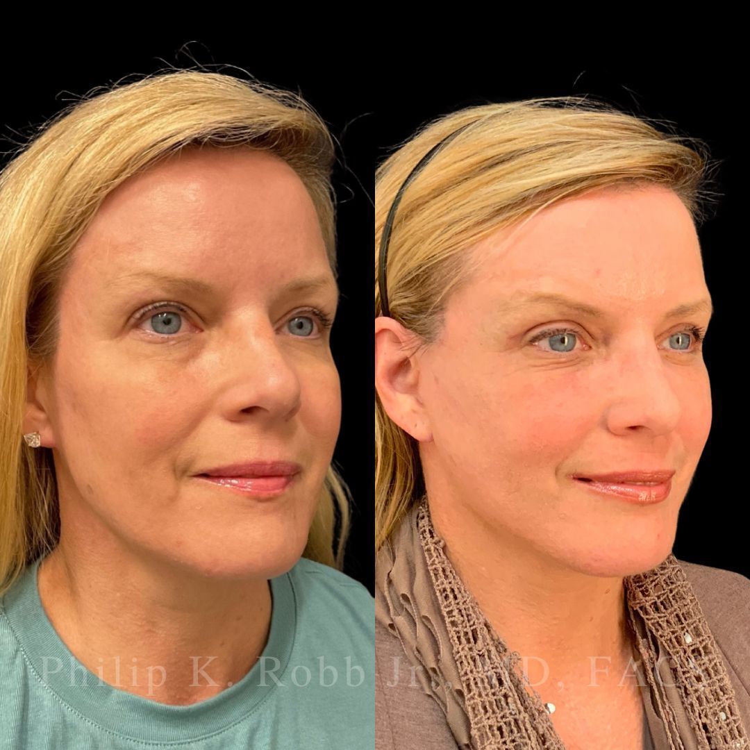 RobbJrMD's tweet image. Swipe to zoom in on the DETAILS 👀

This patient is just 8 weeks out from her Robb Refresh🙌🏼

When we lift in the deep plane, we’re not pulling the skin — we’re moving the actual aging structures back to where they lived years ago🤩