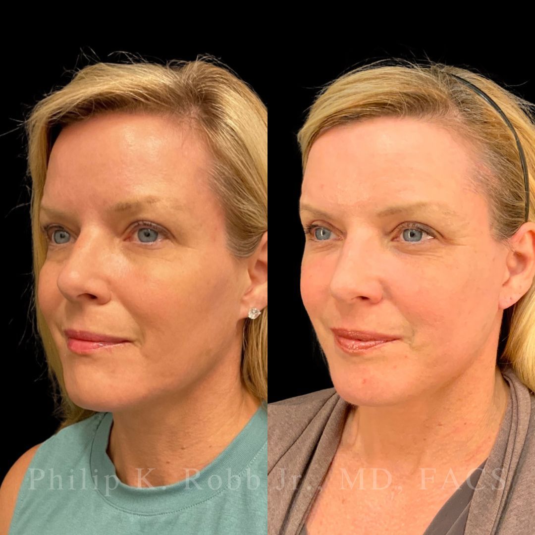 RobbJrMD's tweet image. Swipe to zoom in on the DETAILS 👀

This patient is just 8 weeks out from her Robb Refresh🙌🏼

When we lift in the deep plane, we’re not pulling the skin — we’re moving the actual aging structures back to where they lived years ago🤩