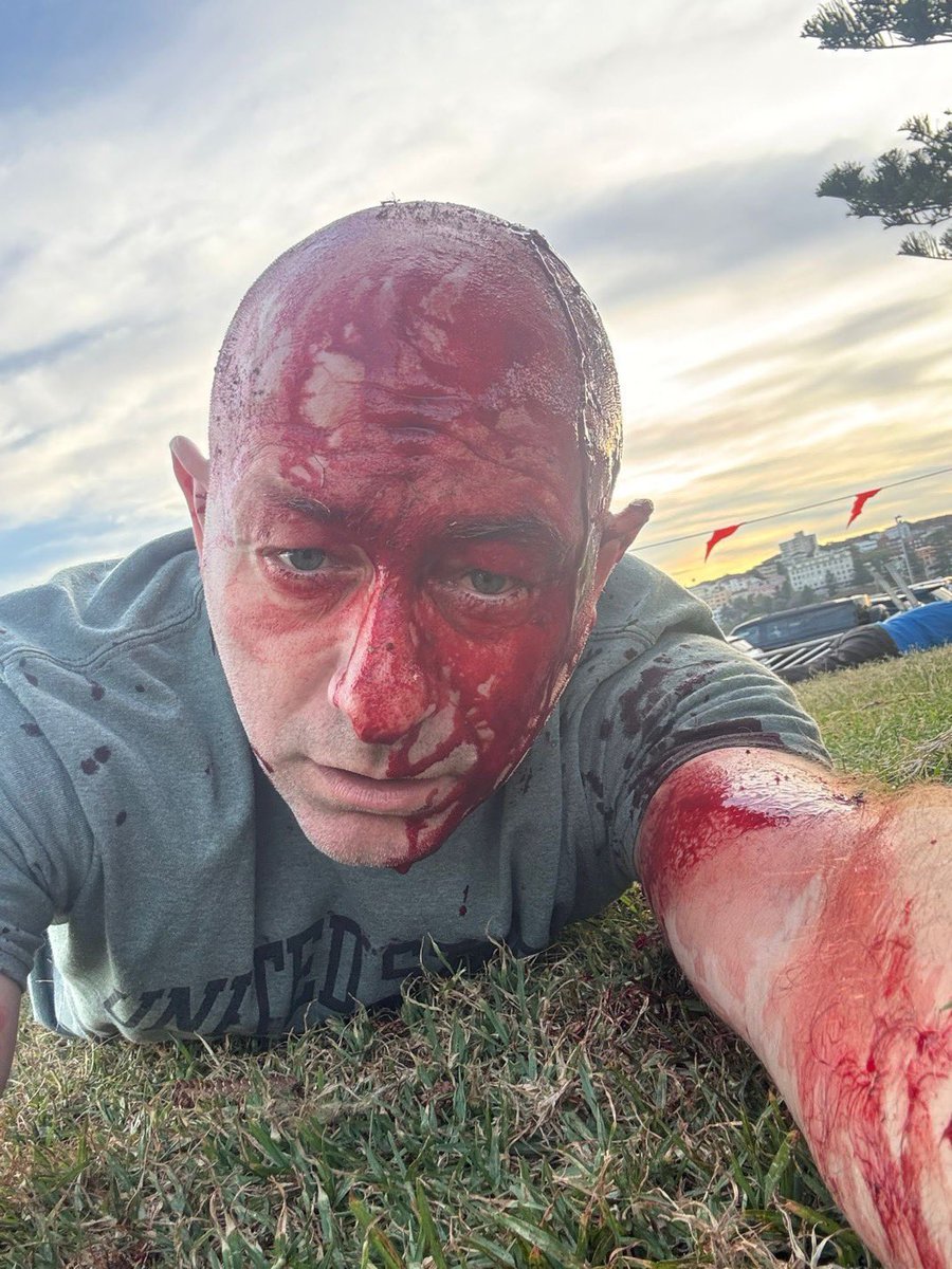 Human rights lawyer Arsen Ostrovsky shared a photo after being shot at Bondi Beach in Sydney. He survived. A shocking incident.