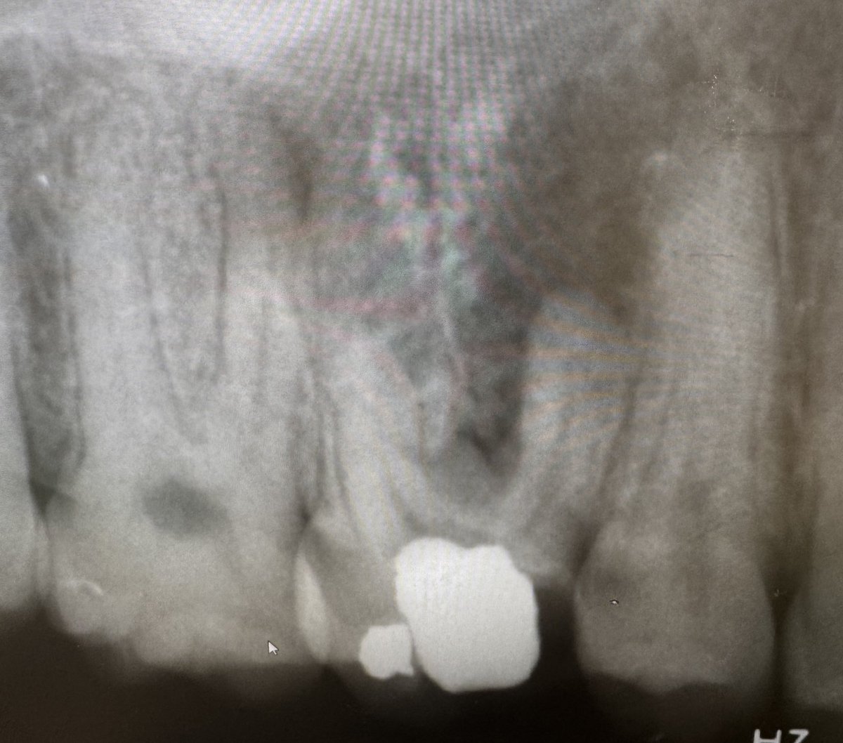 What a challenge 🧨
Restorabily check was done ✅

Dx: Necrotic pulp with acute apical abscess.