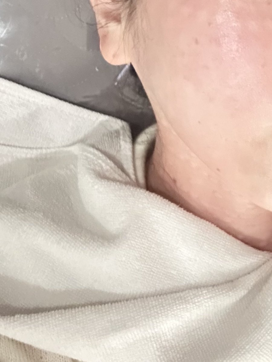 micokt's tweet photo. 韓国のおすすめ美容クリニック🇰🇷江南のnyunyu house横のビルにあるON医院がめちゃくちゃよかった！肌診断超細かいし、パーソナルカラーまで見れるのすごい。リジュランもめちゃくちゃうまい！いつも叫ぶほど痛いんだけど叫ばずできた🤣
@ONclinic_korea PR https://t.co/u5fKe6joYT