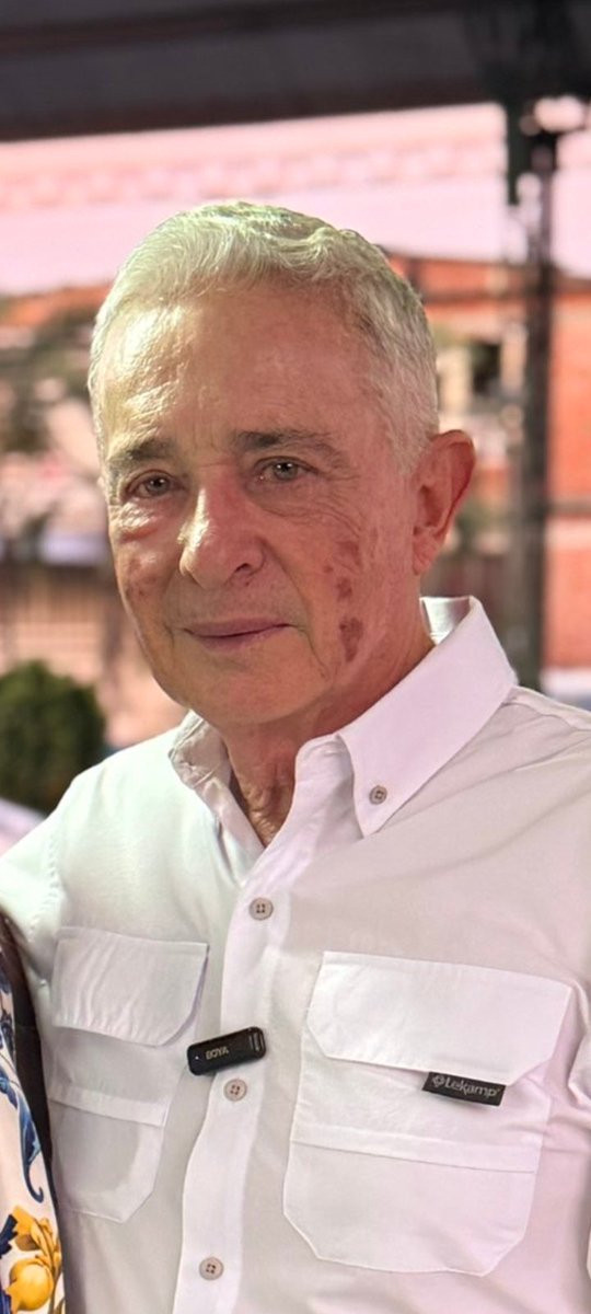 Este señor se ve agotado, se ve ya con el cansancio de su edad, con la plata que tiene estuviera relajado en su finca   disfrutando del amor de sus nietos y familia , Dios quiera y no tenga Melanoma 6402, sería triste una enfermedad así.