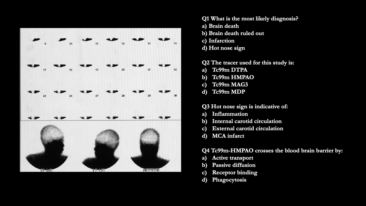 NuclearMD's tweet photo. Case Challenge: # 47
Test your skills by providing answers in comments. Come back to check the answer key in 24 -48h.
Get all the cases at: https://t.co/xWiTQdHGvq
#radiology #nuclearmedicine #PETCTScan #nucmed #radres #imaging https://t.co/a3lhoI8NOJ