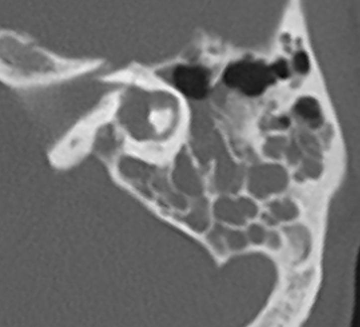 jjgarnham's tweet photo. 🩻Incidental incomplete partition (IP) type II on a trauma CT, with a dilated vestibule and enlarged vestibular aqueduct (the Mondini triad!). There is also a fracture through the otic capsule involving the basal turn of the cochlea.

💡In IP, you have separation of the cochlea and vestibule (cf. common cavity), normal external cochlear dimensions (cf. cochlear hypoplasia), but various defects of internal architecture.

1⃣ IP type I: the cochlea is "empty" and cystic, with no clearly formed turns.
2⃣ IP type II: confluence of the middle and apical turns, with a deficient apical modiolus and interscalar septum, but a formed basal turn. If this occurs with a dilated vestibule and an enlarged vestibular aqueduct, you have the classic Mondini malformation.
3⃣ IP type III: the cochlea has a typical "corkscrew" appearance. This is seen with POU3F4 mutations in X-linked deafness.