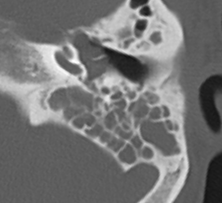 jjgarnham's tweet photo. 🩻Incidental incomplete partition (IP) type II on a trauma CT, with a dilated vestibule and enlarged vestibular aqueduct (the Mondini triad!). There is also a fracture through the otic capsule involving the basal turn of the cochlea.

💡In IP, you have separation of the cochlea and vestibule (cf. common cavity), normal external cochlear dimensions (cf. cochlear hypoplasia), but various defects of internal architecture.

1⃣ IP type I: the cochlea is "empty" and cystic, with no clearly formed turns.
2⃣ IP type II: confluence of the middle and apical turns, with a deficient apical modiolus and interscalar septum, but a formed basal turn. If this occurs with a dilated vestibule and an enlarged vestibular aqueduct, you have the classic Mondini malformation.
3⃣ IP type III: the cochlea has a typical "corkscrew" appearance. This is seen with POU3F4 mutations in X-linked deafness.