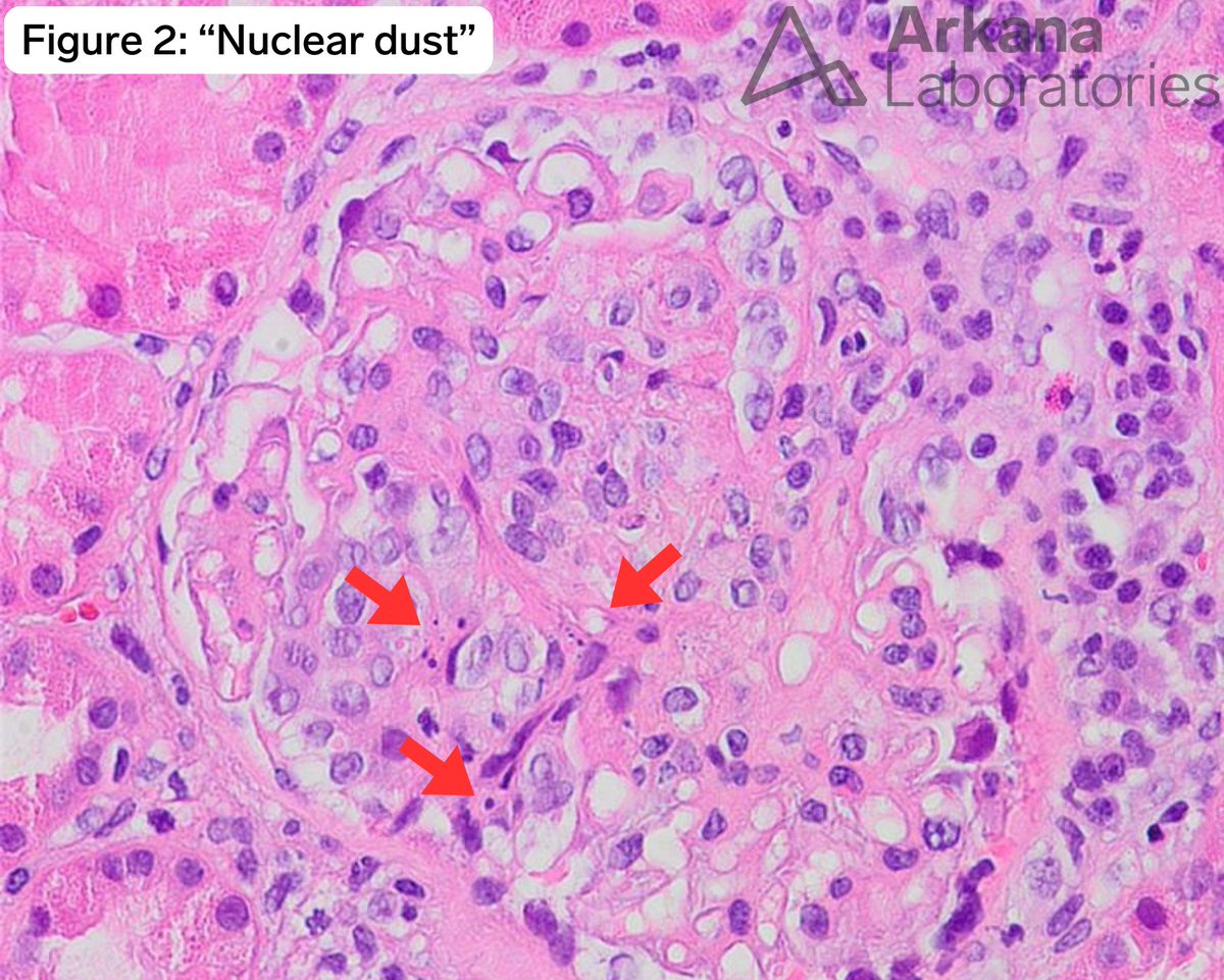 12 Days of Lupus Scoring Findings

Day 11: Neutrophil infiltration and/or karyorrhexis. Increased infiltration of the mesangium or capillary spaces, specifically by neutrophils, and/or presence of karyorrhexis (nuclear "dust"/debris from cellular destruction).