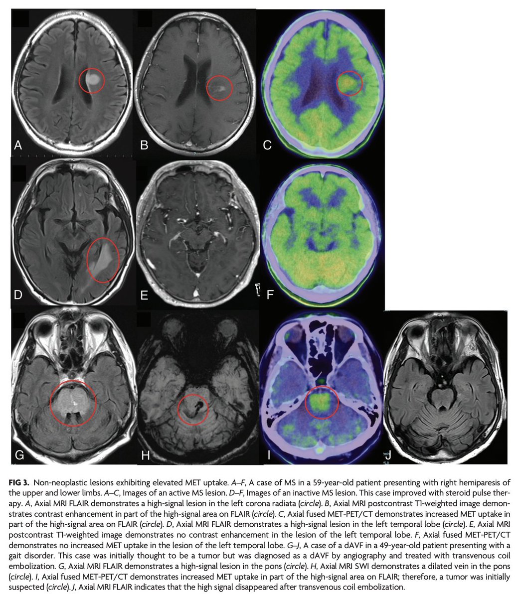 TheAJNR's tweet image. "Methionine PET Findings in the Diagnosis of Brain Tumors and Nontumorous Mass Lesions: A Single-Center Report on 426 Cases"

doi.org/10.3174/ajnr.A…