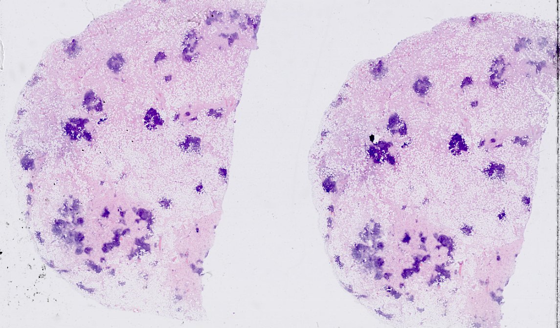 SumantaDas_7's tweet image. Adult male. Retroperitoneal mass. 
#PathX #PathTwitter #BSTPath