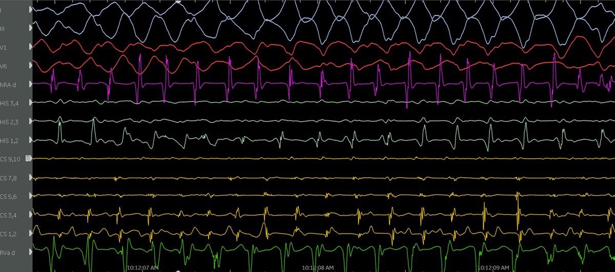 Teebi_MD's tweet photo. This is exactly why we do #EP study in asymptomatic pre-excited patients. To risk stratify accessory pathways!

Young patient with manifest posteroseptal AP.  During EP study, pre-excited sinus rhythm degenerated before our eyes:

Sinus-->AFib-->AFL 1:1--> PMVT/VF --> shocked https://t.co/qSjZwSPhRy