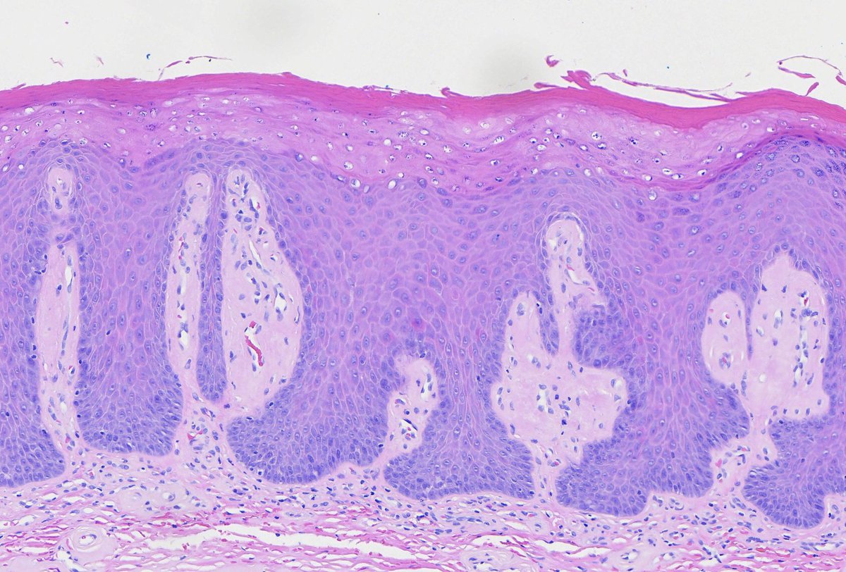 TobyASchmitt's tweet photo. Squamous epithelium with a sharply-demarcated area of necrosis is a typical finding in external/mechanical injury. This biopsy was from the oral cavity of a man with a history of chewing tobacco use.

WSI:
https://t.co/oerA6U6bwS https://t.co/4mgcyPB8jb