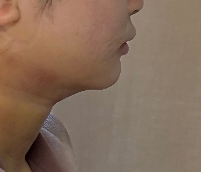 y_chan___36's tweet photo. 顔(頬、ジョール、顎下)脂肪吸引＋糸リフト
DT2日目

ジョールのたまってた脂肪マシになってる気がする！嬉しい
フェイスライン全然スッキリしてなくて不安、腫れ引いたらピタッとしてくれるかな🥲
顎の真下部分感覚なくて気持ち悪い
洗顔と歯磨き以外ずっとフェイスバンド巻いてる(巻いてた方が楽) https://t.co/orR1U8HU3b