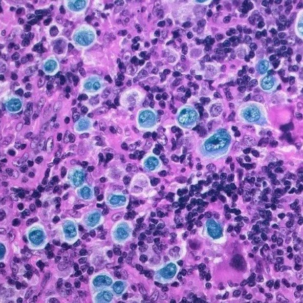 ISRAEL REPORTÓ REMISIÓN COMPLETA EN UN TRATAMIENTO PARA UN TIPO DE CÁNCER AVANZADO

Un estudio realizado en 15 centros de salud mostró que el 95% de los pacientes tratados logró remisión total con un nuevo esquema terapéutico, incluso en estadios avanzados, con una supervivencia