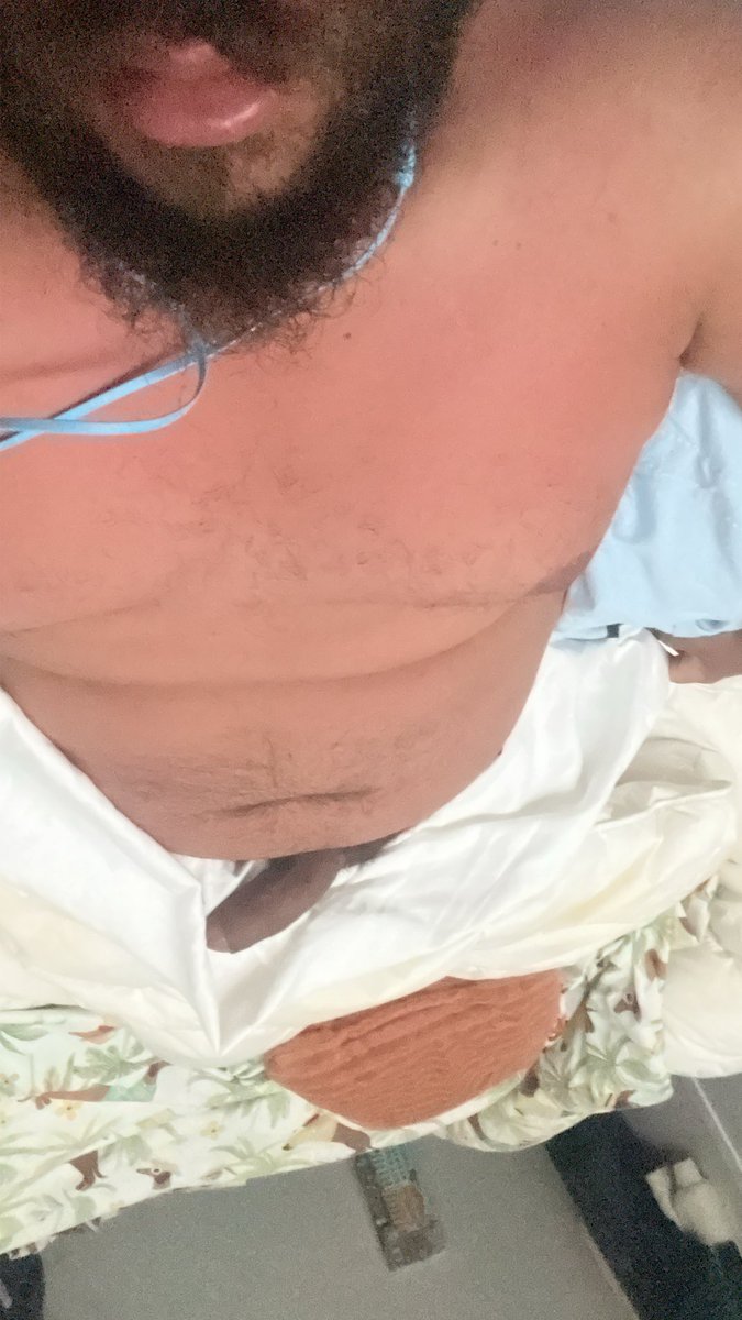 Sunburn 🥲