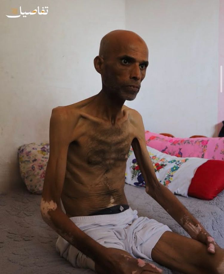 QudsNen's tweet image. 47-year-old Faisal Mohammed Abu Zaher from Al-Bureij Refugee Camp has lost the ability to walk due to severe malnutrition and worsening bone fragility. 

His weight has dropped from 75 kg to just 35 kg, and he urgently requires gluten-free medical nutrition and regular treatment…