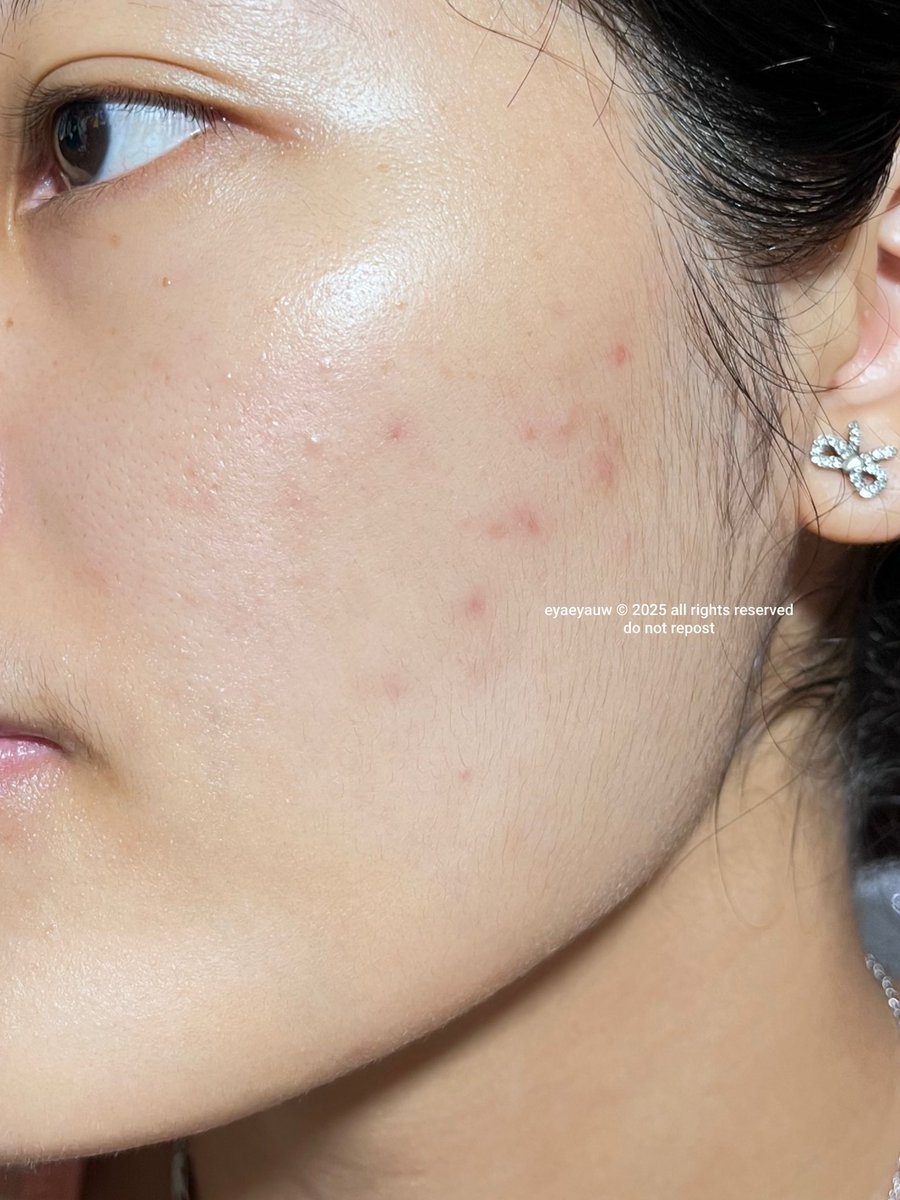 eyaeyauw's tweet image. thanks to my affordable acne serum that calming my acne🥹☝🏻within a week my skin is getting better 

from this to this