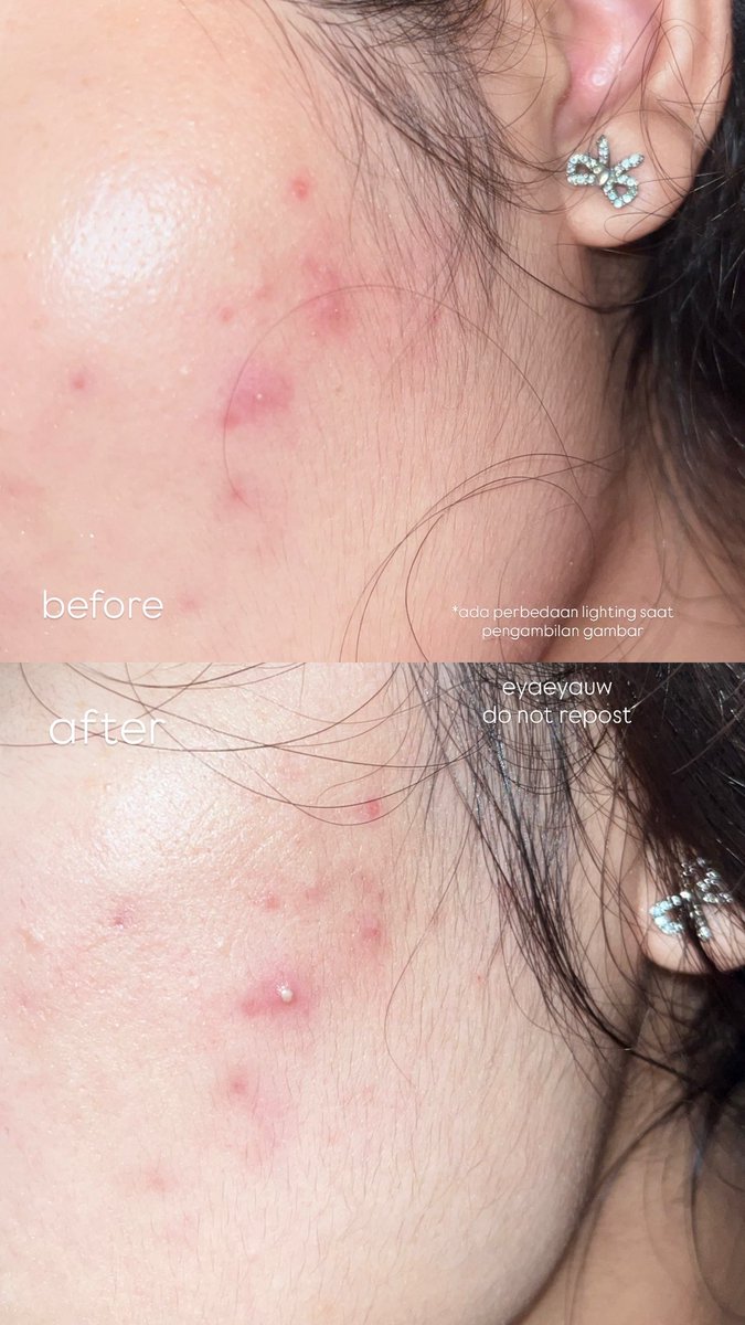 eyaeyauw's tweet image. thanks to my affordable acne serum that calming my acne🥹☝🏻within a week my skin is getting better 

from this to this
