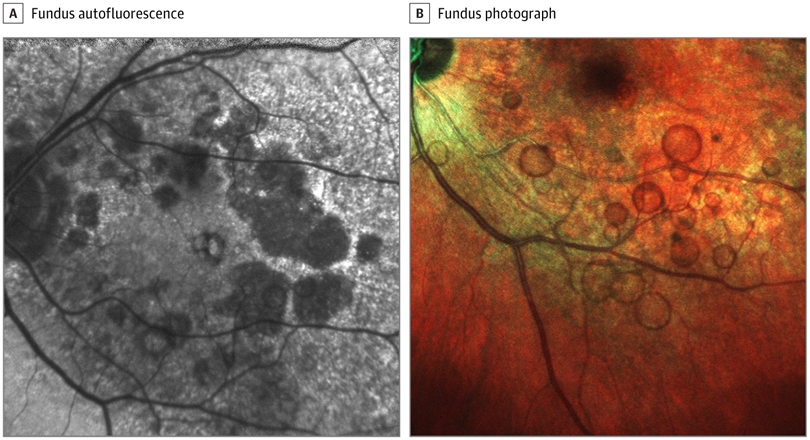 JAMAOphth's tweet photo. Multicolor imaging revealed a novel epiretinal hyperproliferative complex in a patient with persistent visual symptoms post-cataract surgery. https://t.co/IKP36asYC1 https://t.co/tJGokGZkxA