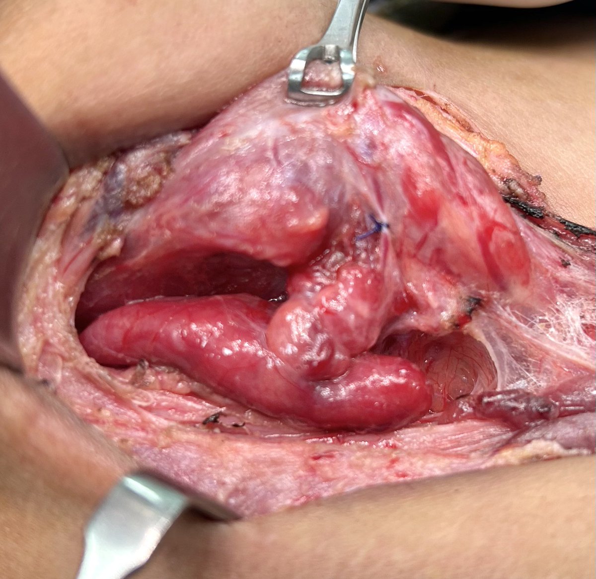 AsadAzim's tweet photo. Parathyroid Adenoma - spanning from Sup to Inf Thyroid pole. PTH >2500. SPECT/CT sestamibi : unable to localize.
#parathyroid #EndocrineSurgery #Parathyroidectomy #SurgicalOncology https://t.co/U1eM5x8WZ9