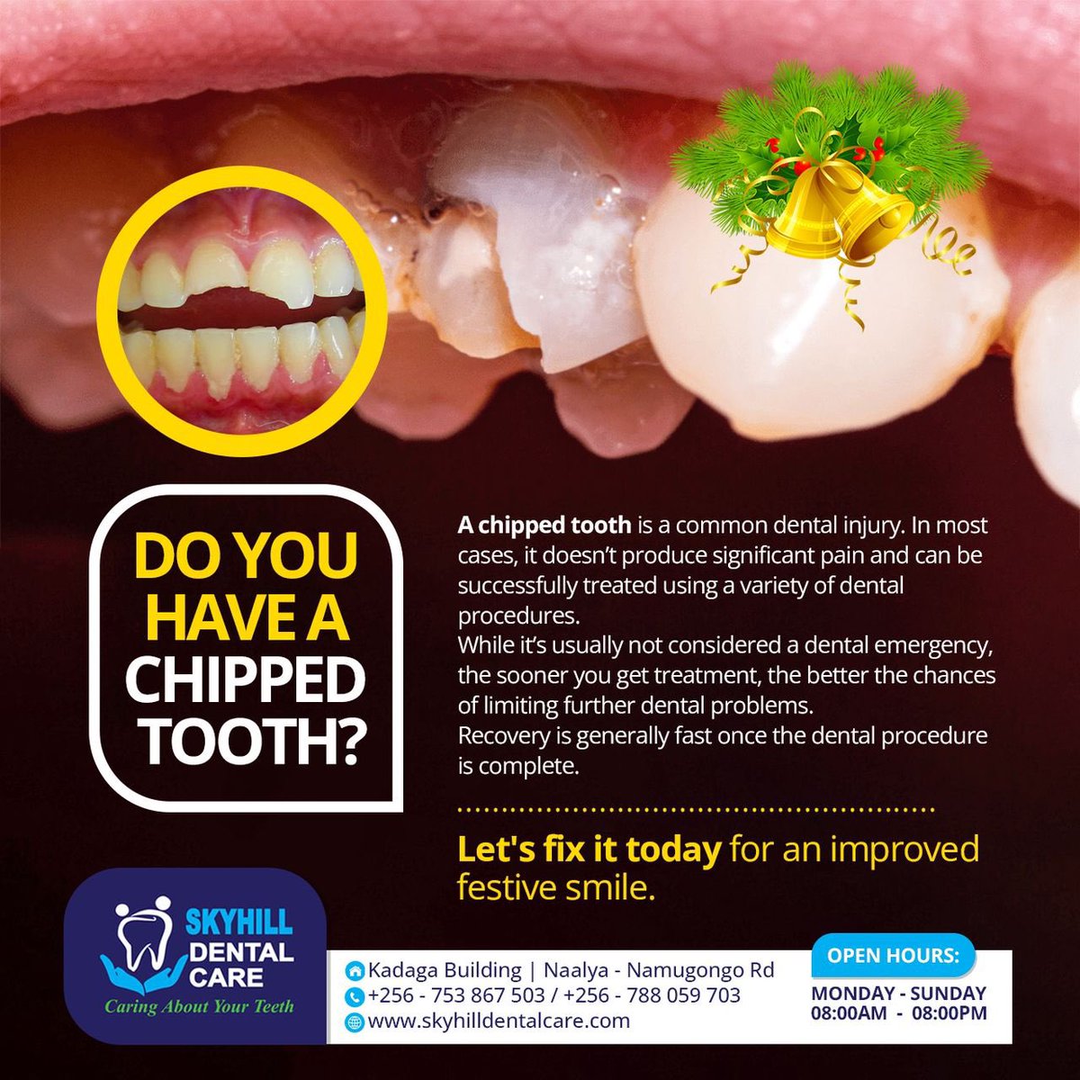 Skyhilldental's tweet photo. A chipped tooth is a common injury that can range from a small corner to a more significant part of the tooth.
At SkyHill Dental Care, we are here to fix you for a new smile!
Visit us at Naalya - Namugongo Road at Kadagga’s Building.
See you soon!
#ChippedTooth #FixingSmile https://t.co/izl1cKtPoC