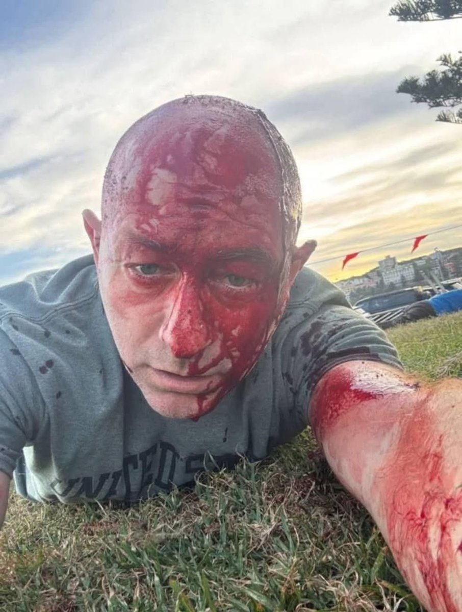 Mr. Ostrovsky przeprowadził się do Australii zaledwie dwa tygodnie temu, aby pomóc w walce z rosnącym antysemityzmem.
Dziwna ta krew, ze nie zasycha, i taka rozwodniona... charakteryzacja jak po ataku rekina, jak na plaze przystalo