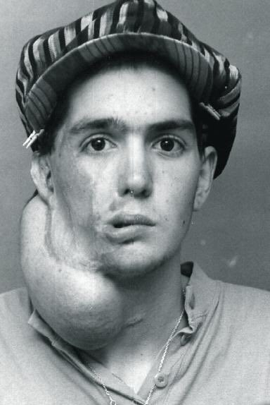 El 14 de diciembre de 1991, en Pamplona, la policía cargó con extrema violencia contra una manifestación de solidaridad con presos. Mikel Iribarren, un joven de 18 años, fue alcanzado por una lata de humo lanzada directamente a su cara por un agente. La explosión le causó heridas