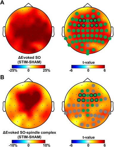 [Epilepsy] Kwon et al.: "Auditory-evoked changes in slow oscillations and spindles correlate with memory consolidation in children with epilepsy and controls." doi.org/10.1016/j.clin…
