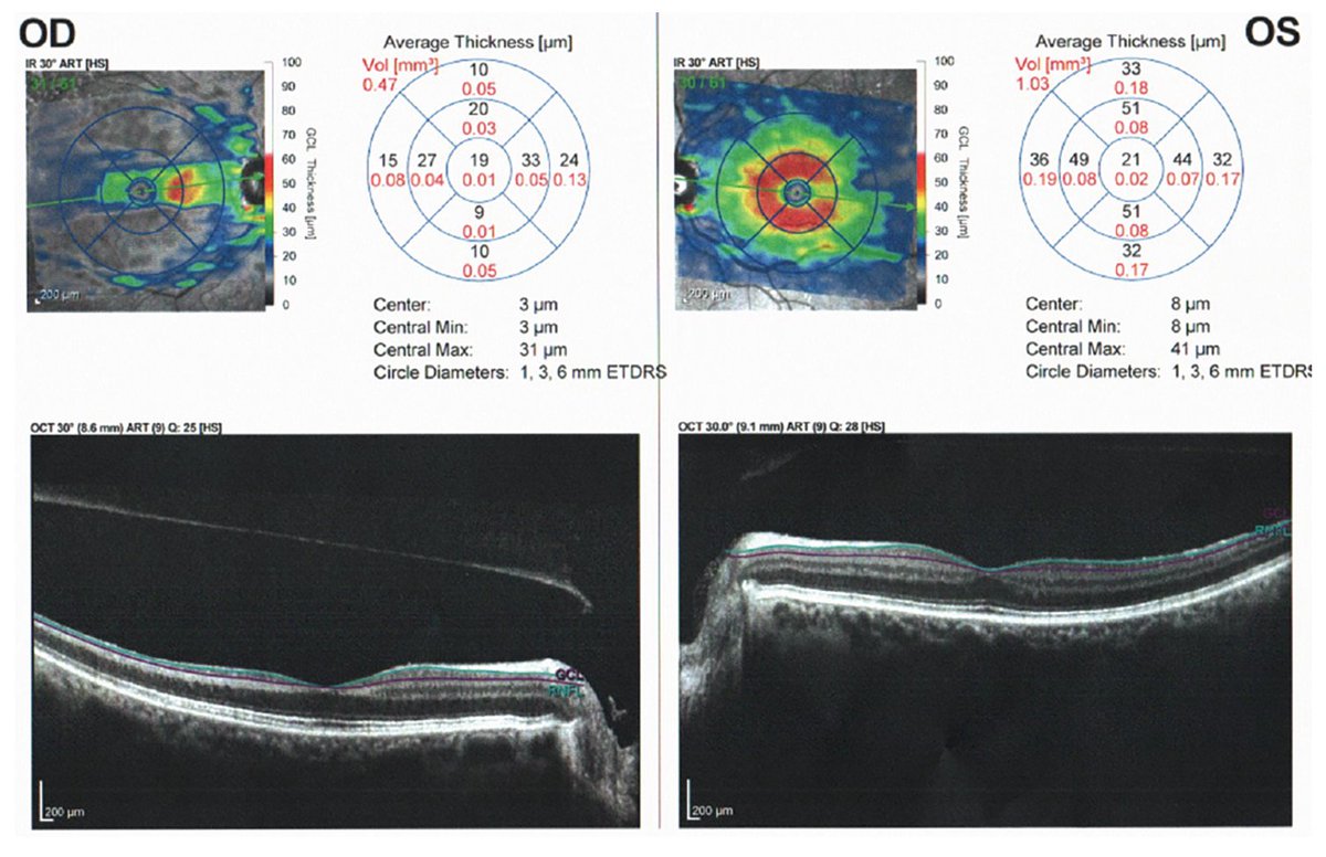RevOphth's tweet image. December 2025 Wills Eye Resident Case Series

An 81-year-old female presents to @Wills_Eye with a one-month history of painless vision loss in the right eye. Full case: reviewofophthalmology.com/article/decemb…
#ophthalmology #eyedoctor #retina #retinaspecialist #willseye #willseyehospital