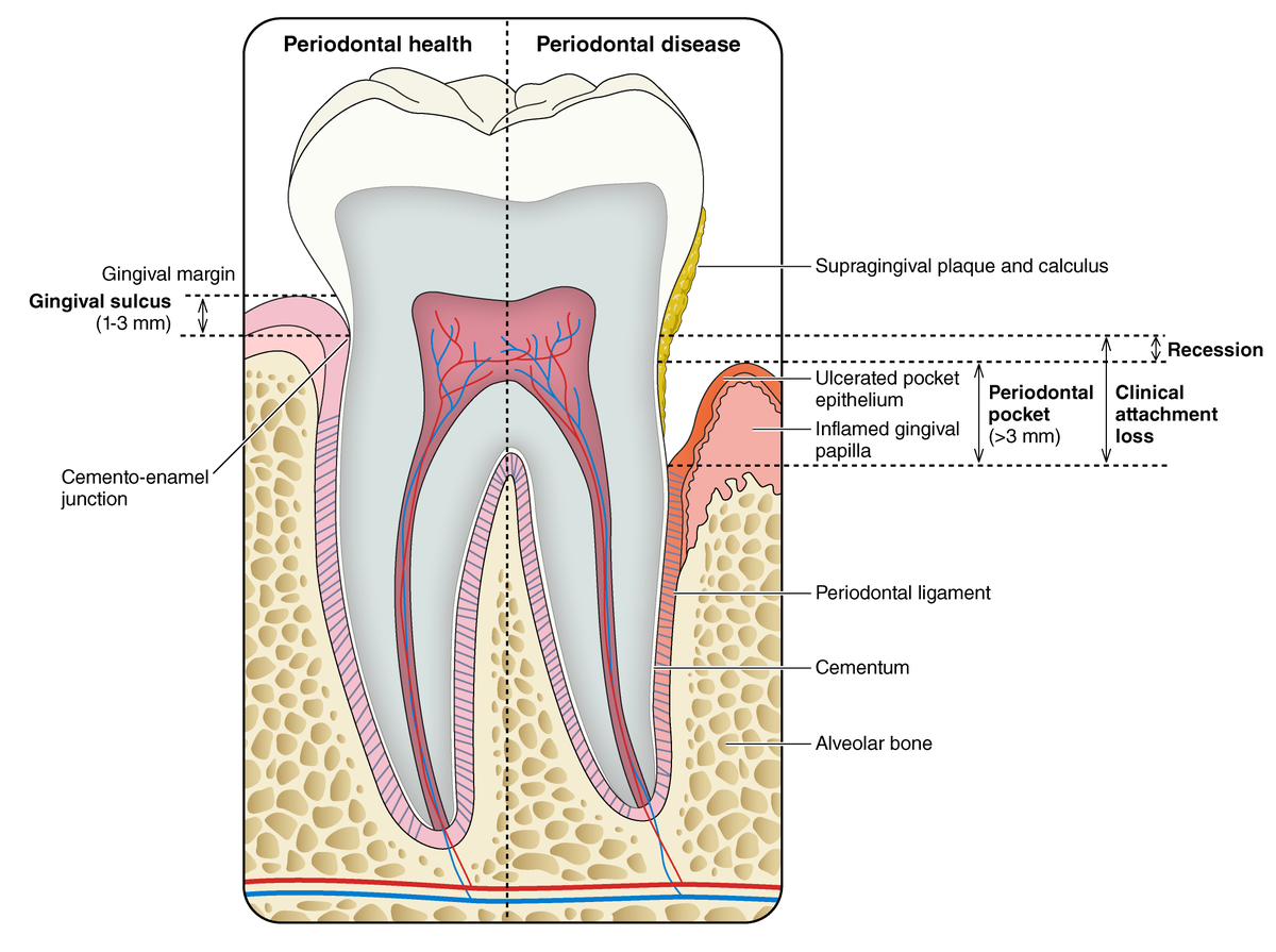 Periodontal disease is a chronic, multifactorial inflammatory condition affecting over 40% of U.S. adults over 30.  It progresses from gingivitis to connective tissue attachment loss and periodontal pocket formation, often followed by destruction of the supporting alveolar bone.