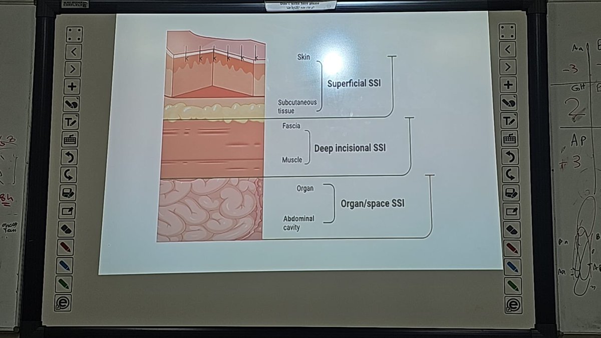 GynOb63095's tweet photo. 🩺✨ 10-Min Talk Recap ✨🩺

A small wound… a big impact 🧵⚠️

Today’s talk focused on Surgical Site Infections (SSI) 🦠🔍
—from superficial to more serious complications 📈

👏 Thank you to Dr. Hajar Almoqbel for the clear and practical presentation 💡📚 https://t.co/EhRHpKQEDe