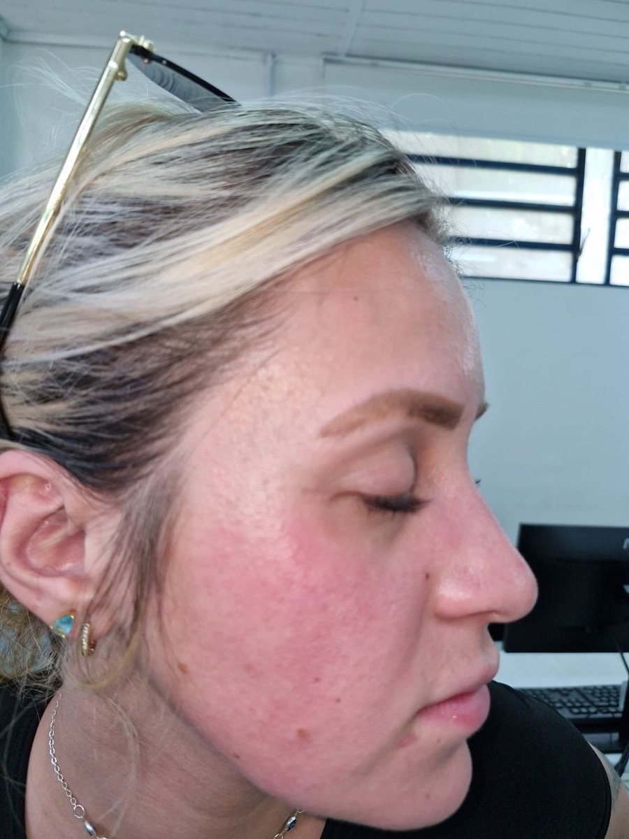 oqueonarutofar1's tweet photo. ainda fica o medo de ter acabado com a saúde da minha pele. Seguem as fotos do estrago (já 3 dias após suspensão do uso! Fiquei tão nervosa que não me atentei a tirar foto quando começou). Ajuda nós @sallve 🥲 https://t.co/56qppKclYi