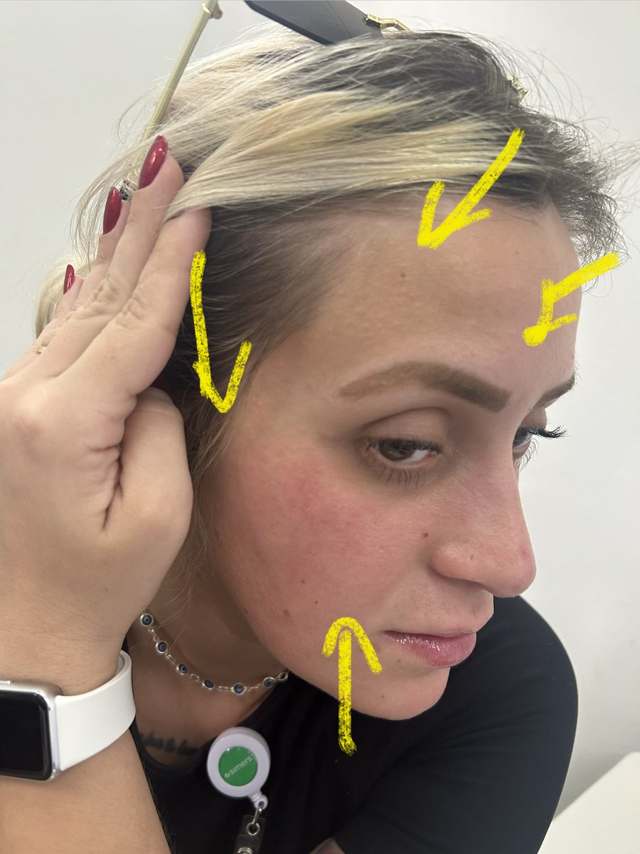 oqueonarutofar1's tweet photo. ainda fica o medo de ter acabado com a saúde da minha pele. Seguem as fotos do estrago (já 3 dias após suspensão do uso! Fiquei tão nervosa que não me atentei a tirar foto quando começou). Ajuda nós @sallve 🥲 https://t.co/56qppKclYi