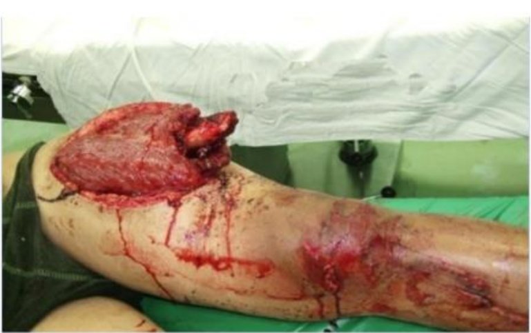 farelrais's tweet photo. Tretment Steps:
1. Primary Survey &amp; Resuscitation
2. Control Bleeding
3. Temporary Immobilization
4. Wound Irrigation
5. Tetanus Prophylaxis
6. Prophylactic Antibiotics
7. Thorough Debridement
8. Repair Structures
9. Fracture Stabilization
10. Wound Coverage https://t.co/3exzGHyGvL