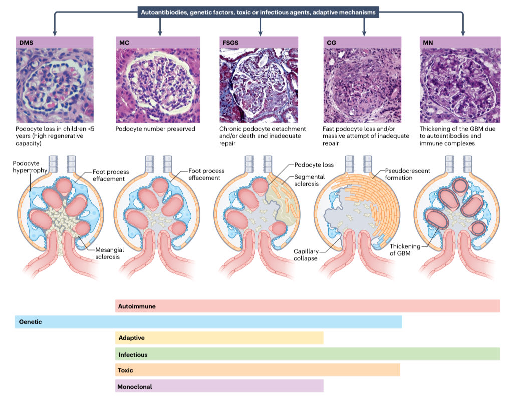 In Podocytopathies, histology labels lesions—etiology dictates therapy. Time for an etiology-based classification. Our new review just out in Nat Rev Dis Primers:
nature.com/articles/s4157…
#Nephrology #PrecisionMedicine #KidneyDisease