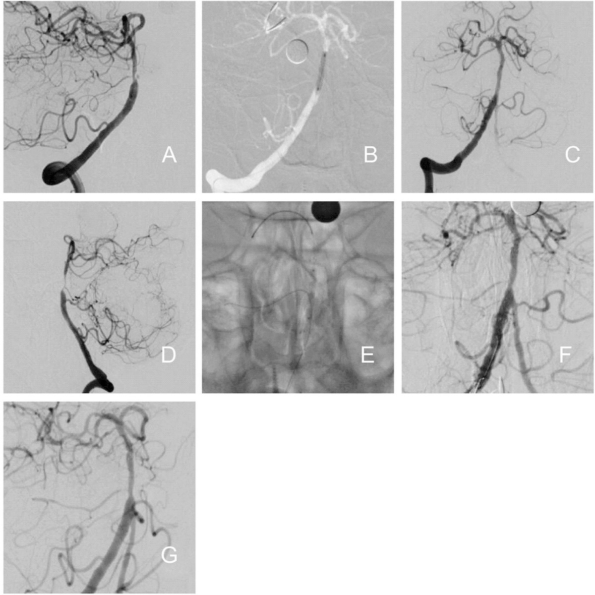 JNIS_BMJ's tweet photo. Restenosis after EVT for sICAS remains a major challenge. 🧠 Salvage EVT was 100% technically successful with no complications—but outcomes differed by strategy. Is Balloon angioplasty + stenting the answer? 👉 https://t.co/je9aSFvGAz
#Stroke #NeuroIntervention #ICAS #ICAD #EndovascularTherapy
