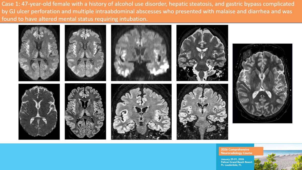 neurokinghippo's tweet image. I am working on the interactive case competition (with prize for the winner!!! 🏆🏆🏆) today. It is always a blast to watch the experts take the cases as TRUE unknowns- come and watch, or view on-demand from your couch!!! An @TheASNR #CNC26 preview...